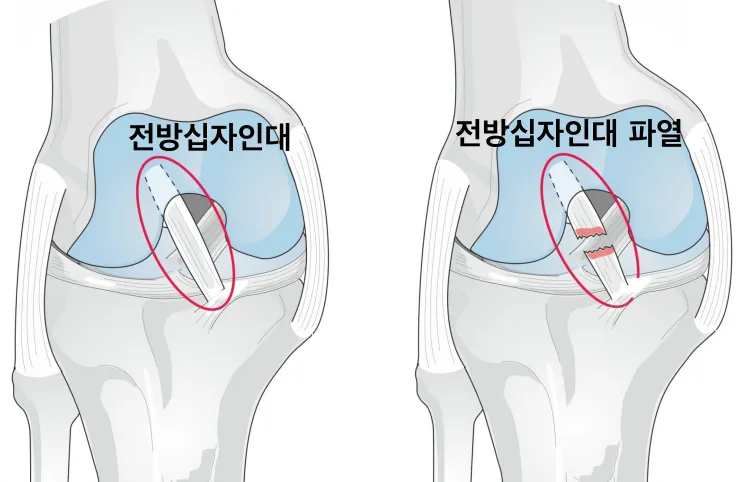 전방십자인대 파열 비수술